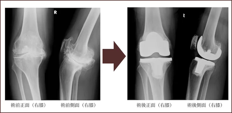 人工膝関節全置換術(TKA)