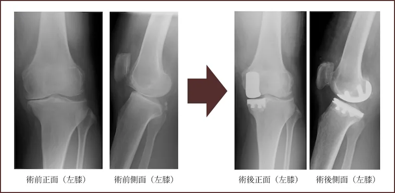 人工膝関節単顆置換術(UKA)