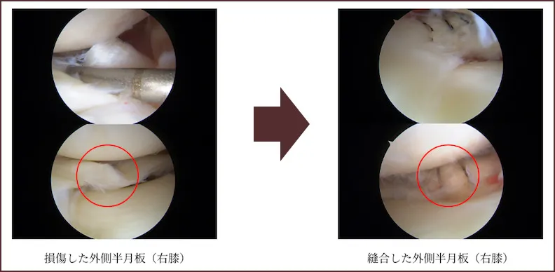 半月板縫合術