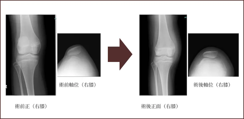 内側膝蓋大腿靭帯再建術